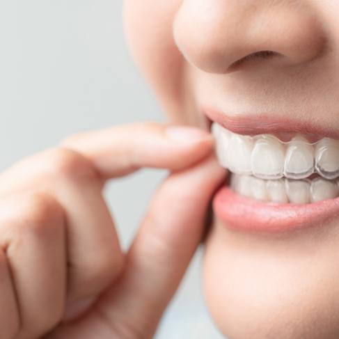 Closeup of patient wearing clear aligner