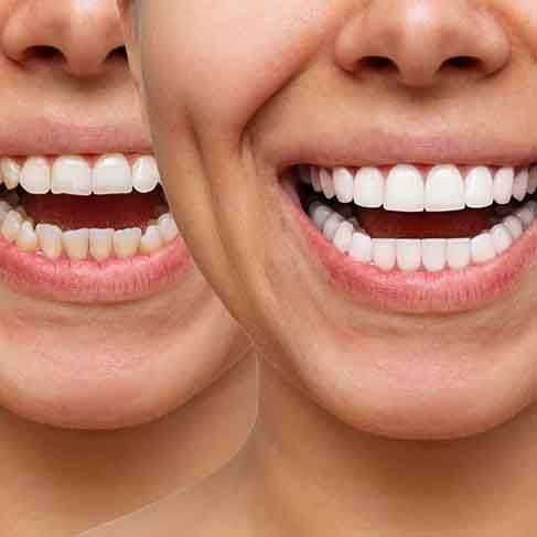 Patient's smile before and after veneers