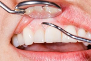 Close up of a dental cleaning