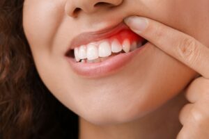 Nose-to-chin closeup of woman lifting her lip with one finger to reveal inflamed gums